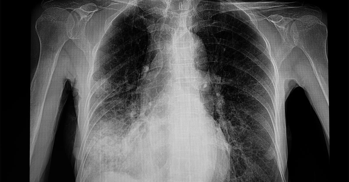 White Lung Disease: The New Global Killer?