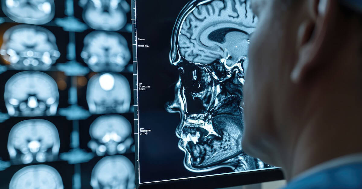 Male patient with previous motorcycle accident displayed leftward midline shift and brain abnormalities on scan.